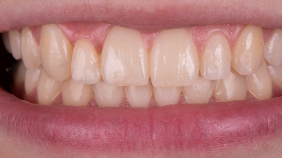 Elegantní řešení chybějící dvojky - foto po